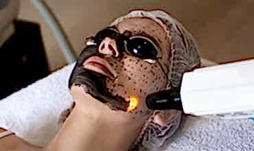 Karbon Peeling